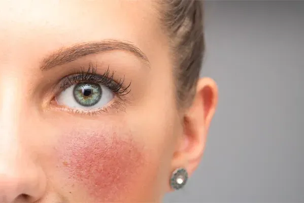 Close-up of a woman with rosacea on her cheeks. Schedule treatment for rosacea from Tanya Zboril, NP of TBT Medical in Edmonton.