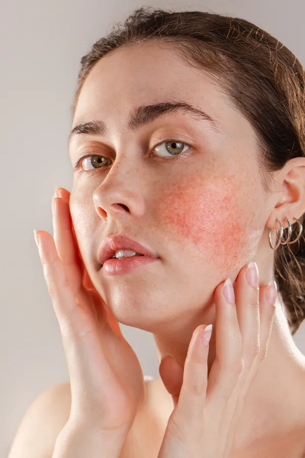 A women framing her face with her hands while inspecting her Rosacea. Receive IPL and Laser Treatment for Rosacea by Tanya Zboril, NP of TBT Medical in Edmonton.